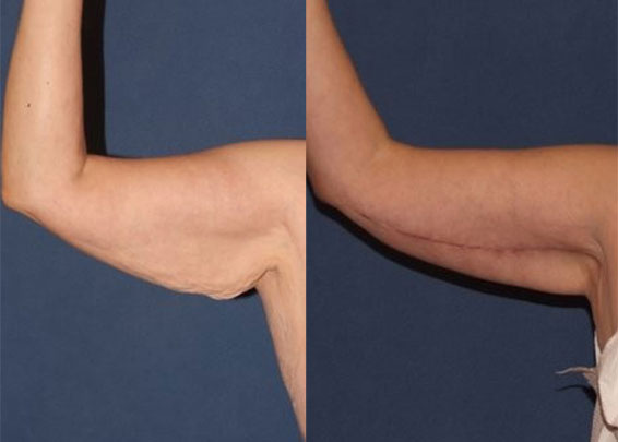درمان شل شدن پوست بازو با پروفیلو