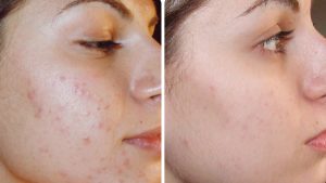 مزونیدلینگ پوست صورت| بهترین روش جوانسازی پوست | کلینیک درمان سلولیت در  اصفهان