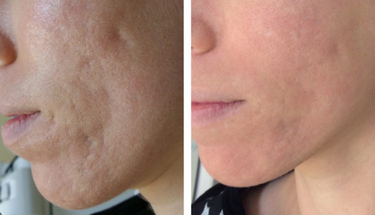Fractional-laser-treatment-of-acne-scars-1296×728-gallery_slide3