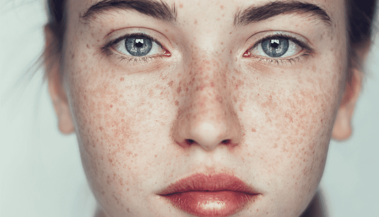 لک های پوستی را چگونه از بین ببریم؟