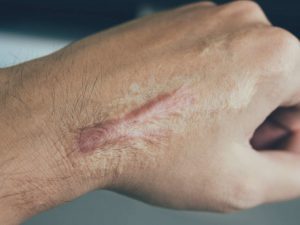 درمان تیرگی و خشکی پوست دست