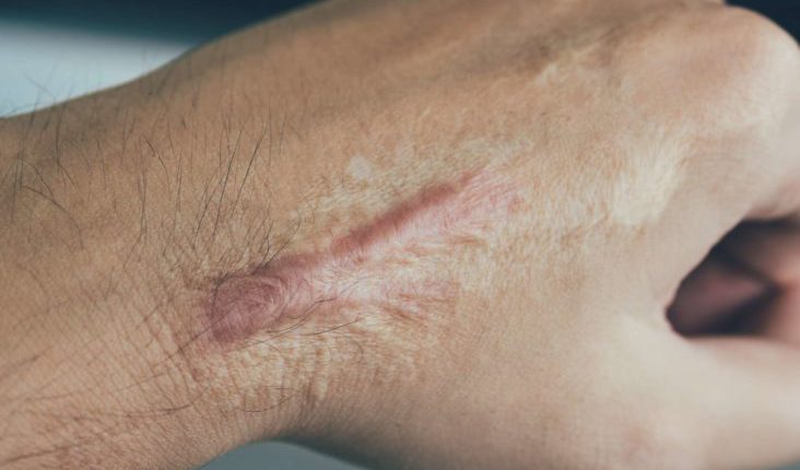 درمان تیرگی و خشکی پوست دست