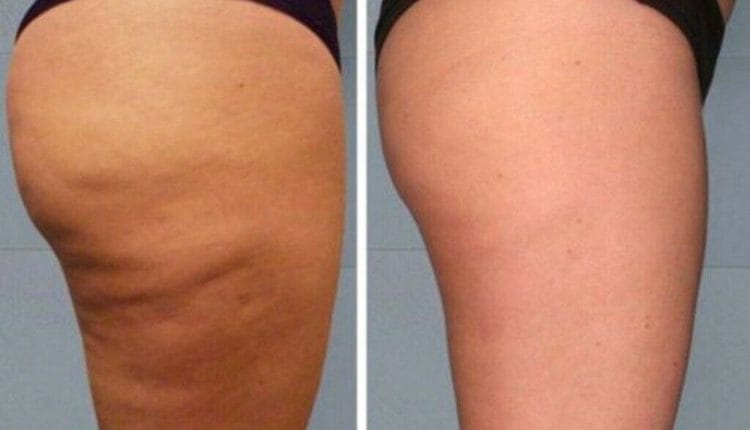 نتیجه ی کربوکسی تراپی سلولیت چقدر ماندگاری دارد؟