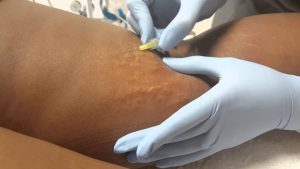 درمان ترک پوستی با کربوکسی تراپی