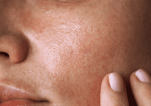 برای پوست چرب چه ضد آفتابی خوبه؟