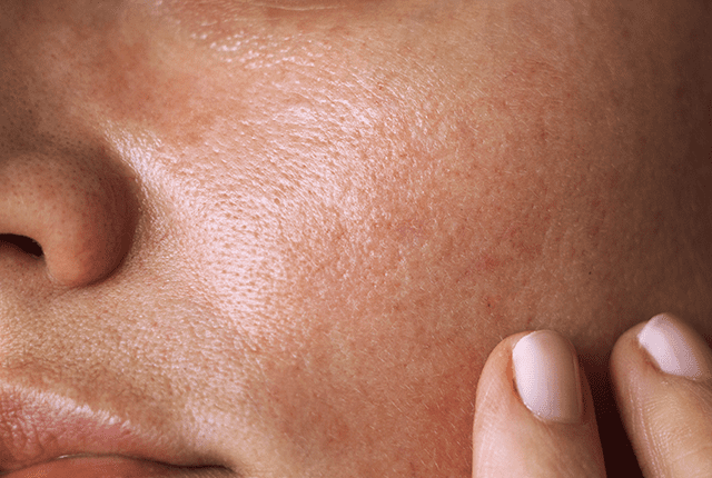 برای پوست چرب چه ضد آفتابی خوبه؟