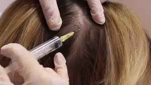 درمان ریزش مو تضمینی