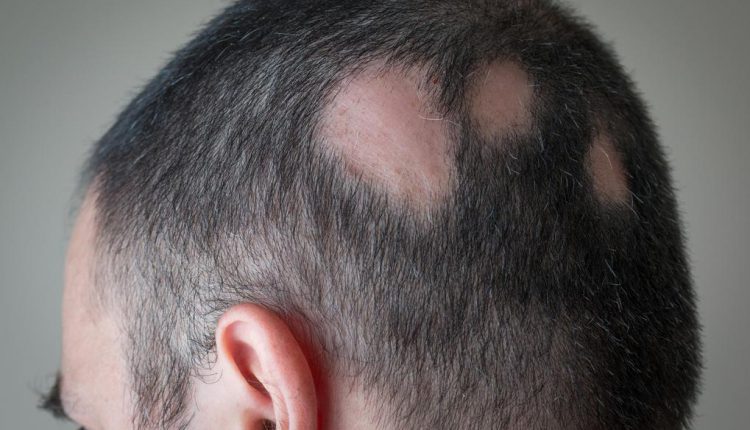 از ریزش مو چگونه جلوگیری کنیم؟