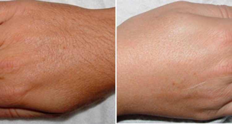 patient-28822-laser-hair-removal-before-after-1200×402