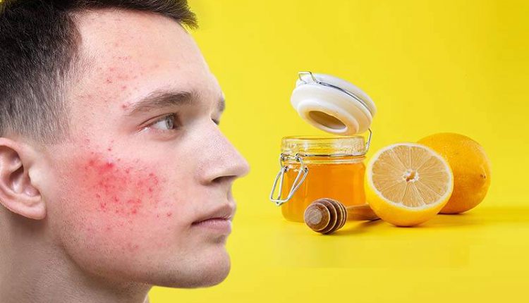 Amazing-honey-and-lemon-mixture-to-get-rid-of-pimples-from-face